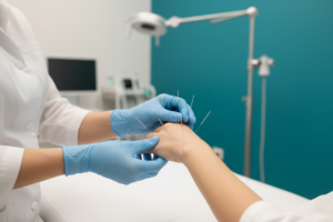 Rheumatoid Arthritis neuro acupuncture and TCM